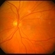 Choroidal Tumor, Breast Cancer